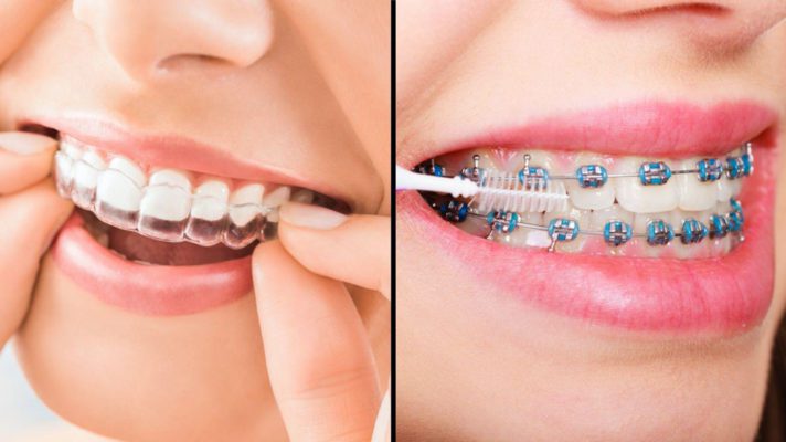 Invisalign Vs. Braces: Which Path To Follow?