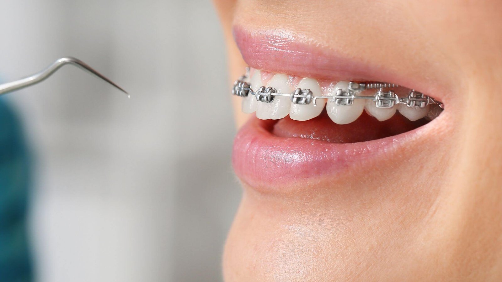 Braces and clear aligners for teeth straightening.