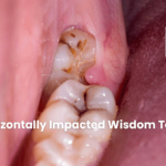 Horizontally-Impacted-Wisdom-Teeth