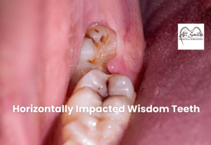 Horizontally-Impacted-Wisdom-Teeth